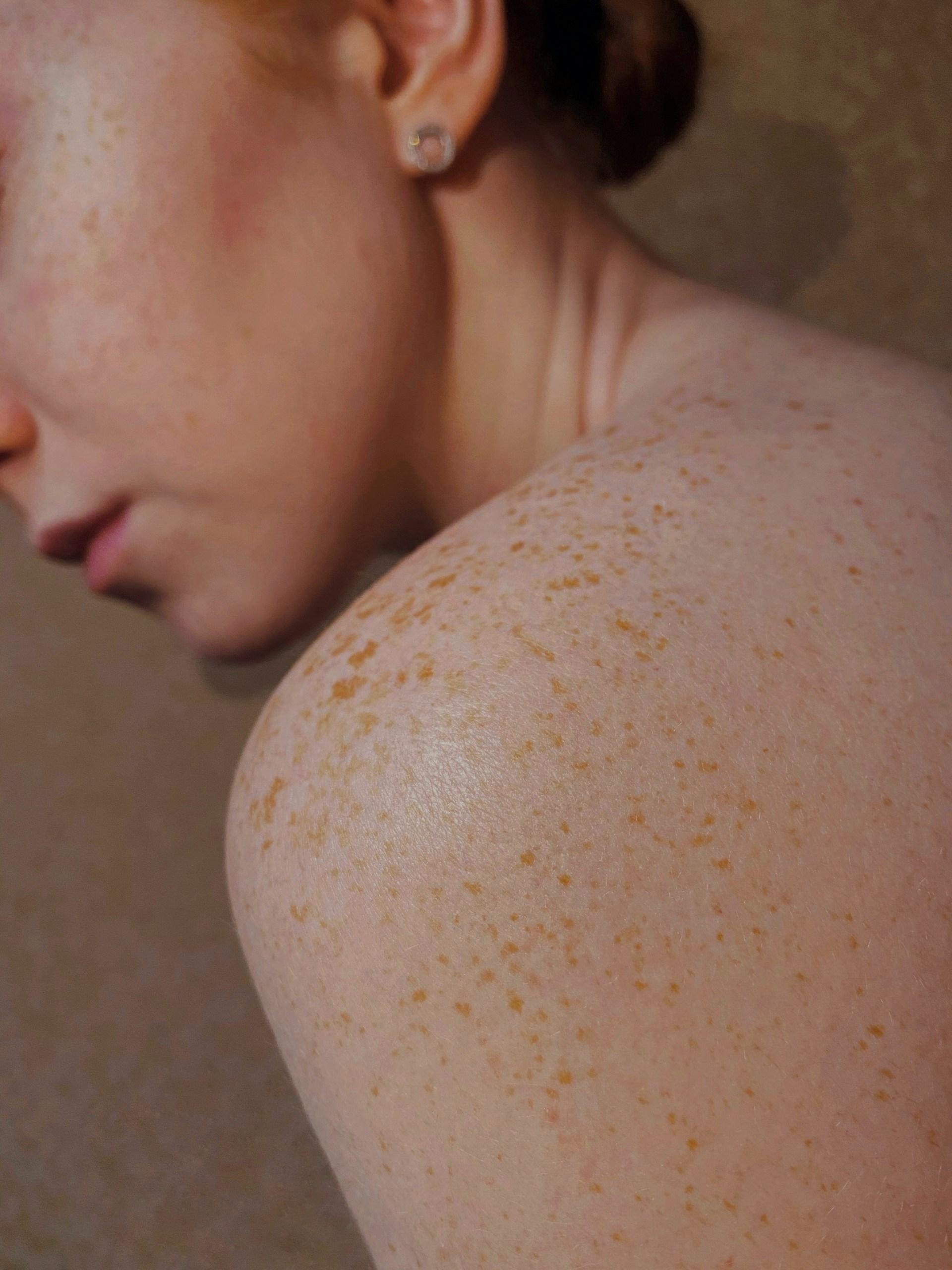 Cover Image for The Hidden Side of Success: Dealing with Loose Skin After Weight Loss